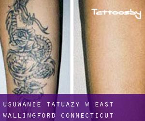 Usuwanie tatuaży w East Wallingford (Connecticut)