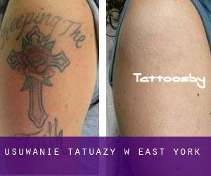 Usuwanie tatuaży w East York