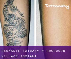 Usuwanie tatuaży w Edgewood Village (Indiana)