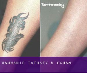Usuwanie tatuaży w Egham
