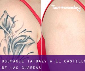 Usuwanie tatuaży w El Castillo de las Guardas
