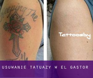 Usuwanie tatuaży w El Gastor