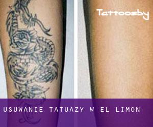 Usuwanie tatuaży w El Limón