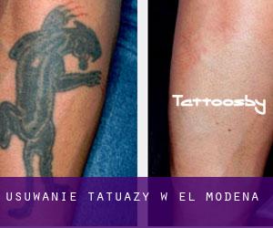 Usuwanie tatuaży w El Modena