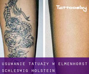 Usuwanie tatuaży w Elmenhorst (Schleswig-Holstein)