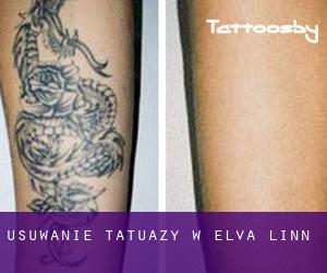 Usuwanie tatuaży w Elva linn