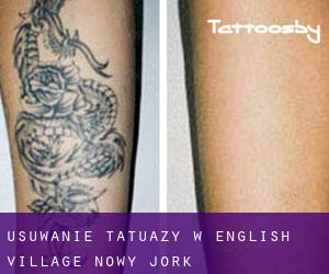 Usuwanie tatuaży w English Village (Nowy Jork)
