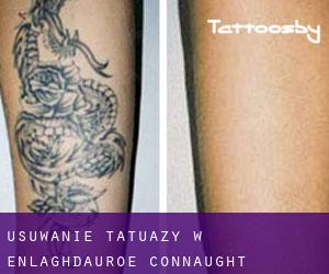 Usuwanie tatuaży w Enlaghdauroe (Connaught)