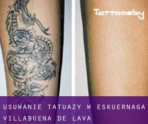 Usuwanie tatuaży w Eskuernaga / Villabuena de Álava