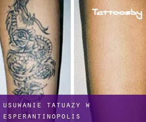 Usuwanie tatuaży w Esperantinópolis