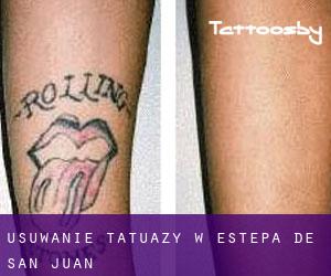 Usuwanie tatuaży w Estepa de San Juan