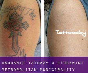Usuwanie tatuaży w eThekwini Metropolitan Municipality