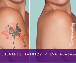 Usuwanie tatuaży w Eva (Alabama)