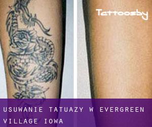 Usuwanie tatuaży w Evergreen Village (Iowa)