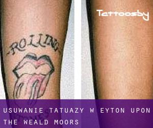 Usuwanie tatuaży w Eyton upon the Weald Moors
