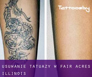 Usuwanie tatuaży w Fair Acres (Illinois)