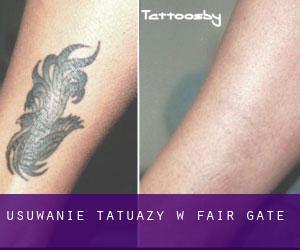 Usuwanie tatuaży w Fair Gate