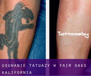 Usuwanie tatuaży w Fair Oaks (Kalifornia)