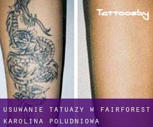 Usuwanie tatuaży w Fairforest (Karolina Południowa)