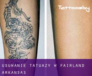 Usuwanie tatuaży w Fairland (Arkansas)