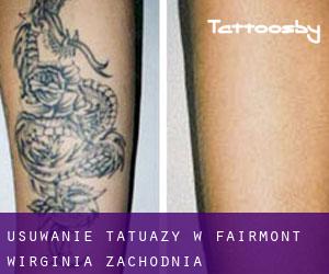 Usuwanie tatuaży w Fairmont (Wirginia Zachodnia)