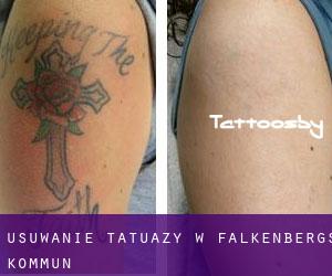 Usuwanie tatuaży w Falkenbergs Kommun