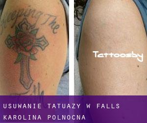 Usuwanie tatuaży w Falls (Karolina Północna)