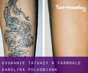 Usuwanie tatuaży w Farmdale (Karolina Południowa)