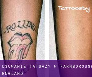 Usuwanie tatuaży w Farnborough (England)