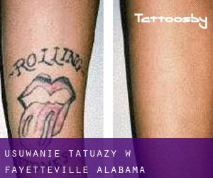 Usuwanie tatuaży w Fayetteville (Alabama)