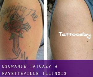 Usuwanie tatuaży w Fayetteville (Illinois)