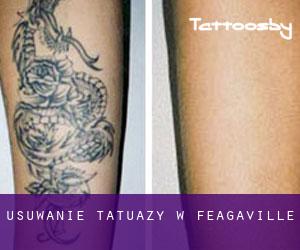 Usuwanie tatuaży w Feagaville