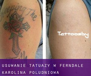 Usuwanie tatuaży w Ferndale (Karolina Południowa)