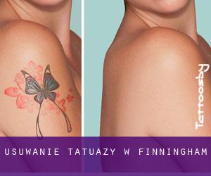 Usuwanie tatuaży w Finningham