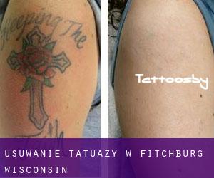 Usuwanie tatuaży w Fitchburg (Wisconsin)