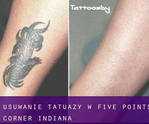 Usuwanie tatuaży w Five Points Corner (Indiana)