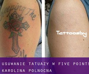 Usuwanie tatuaży w Five Points (Karolina Północna)