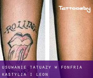 Usuwanie tatuaży w Fonfría (Kastylia i León)