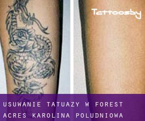 Usuwanie tatuaży w Forest Acres (Karolina Południowa)