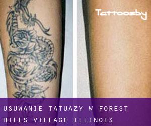 Usuwanie tatuaży w Forest Hills Village (Illinois)