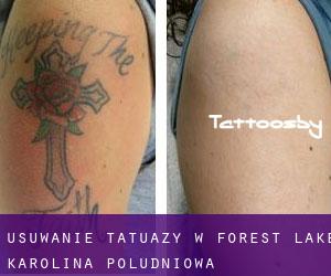 Usuwanie tatuaży w Forest Lake (Karolina Południowa)