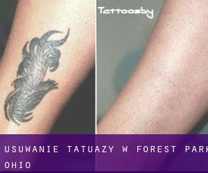 Usuwanie tatuaży w Forest Park (Ohio)