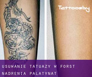 Usuwanie tatuaży w Forst (Nadrenia-Palatynat)