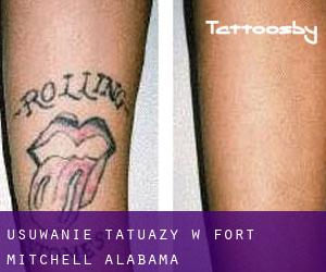 Usuwanie tatuaży w Fort Mitchell (Alabama)