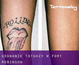 Usuwanie tatuaży w Fort Robinson