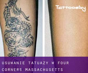 Usuwanie tatuaży w Four Corners (Massachusetts)
