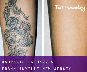 Usuwanie tatuaży w Franklinville (New Jersey)
