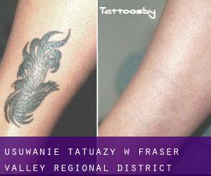 Usuwanie tatuaży w Fraser Valley Regional District