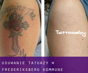 Usuwanie tatuaży w Frederiksberg Kommune