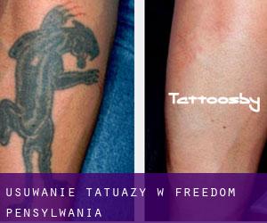 Usuwanie tatuaży w Freedom (Pensylwania)